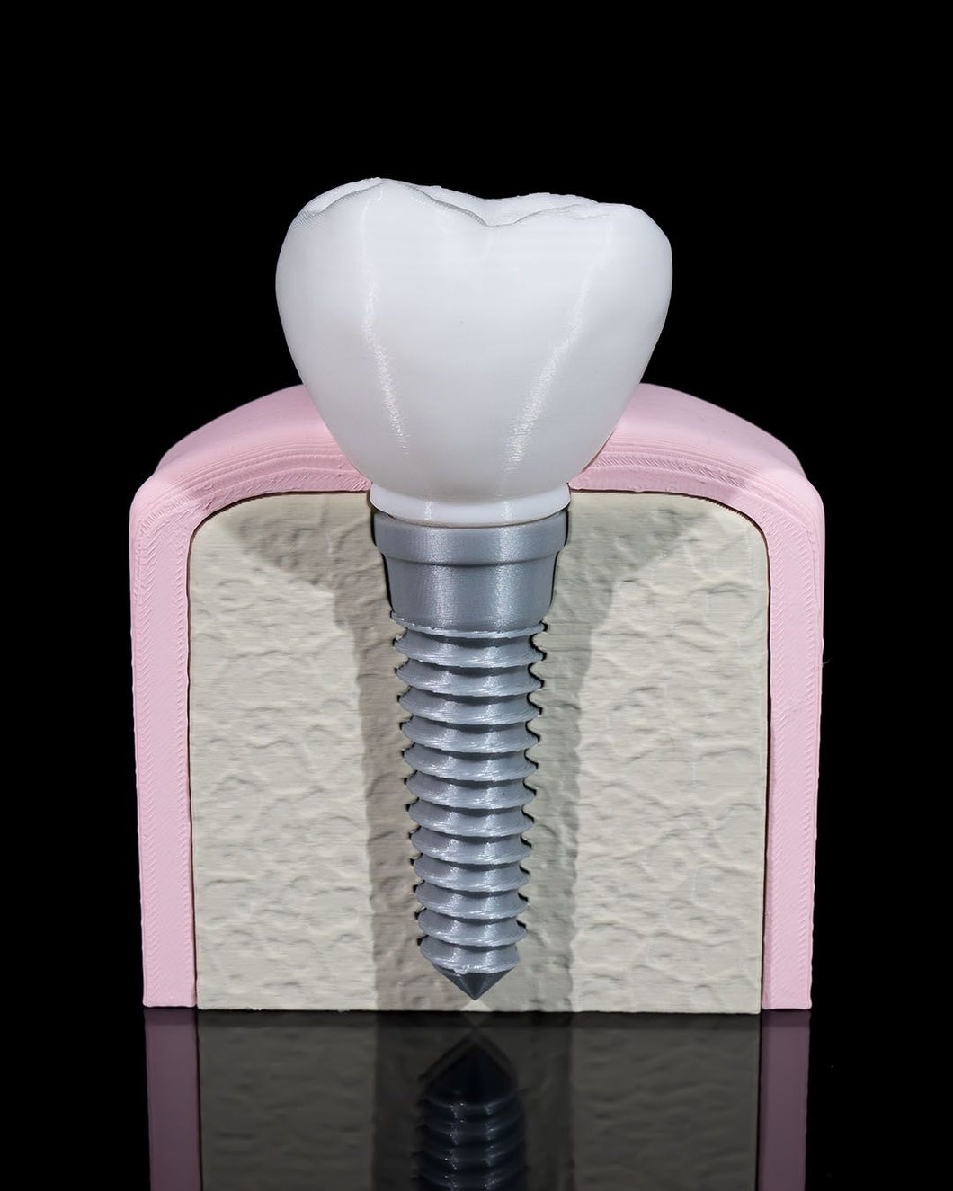 Anatomía - Dental - Implante